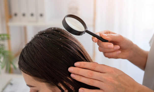 Home Remedies for Dandruff