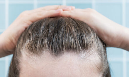 Home Remedies for Hair Thinning